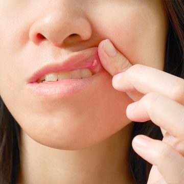 How To Get Rid Of Canker Sores In Longmont, CO?