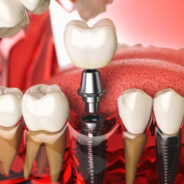 Safe & Effective Pain Relief After Dental Implants