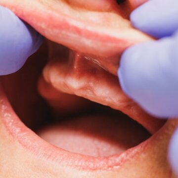 The Secret To Quicker Healing After Dental Implants