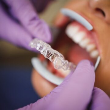 The Magic of Invisalign Treatment: The Best Solution for Crowded Teeth