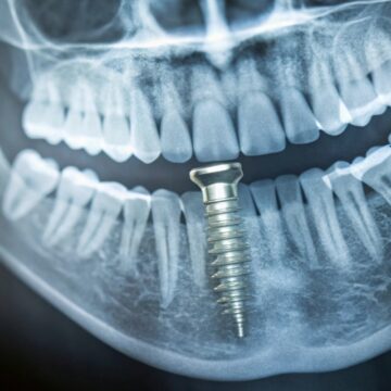 The Best Seasons To Schedule Dental Implants for A Smooth & Stress-Free Recovery
