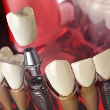 Will Dental Implants Lift Your Face?