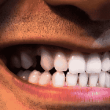 The Hidden Risks of Missing Teeth