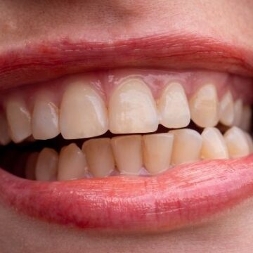 Fixing Stained Teeth: Top Cosmetic Solutions for Discoloration