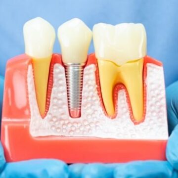 How Safe Are Dental Implants? Risks, Benefits, and Success Rates