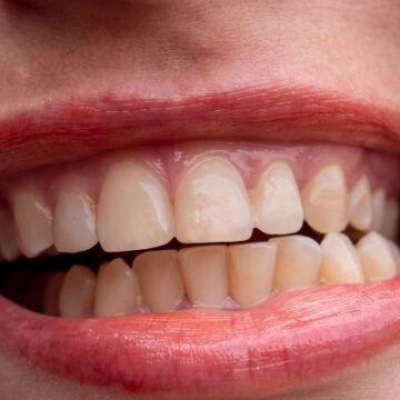 What Actually Works for Stubborn Tooth Stains? A Real Guide