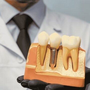 Signs of Dental Implant Failure: What You Should Never Ignore